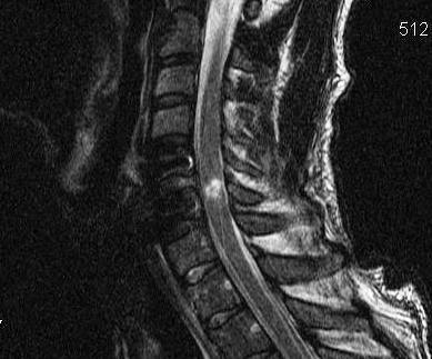 Cervical Cord Injury Post Unilateral Facet Dislocation
